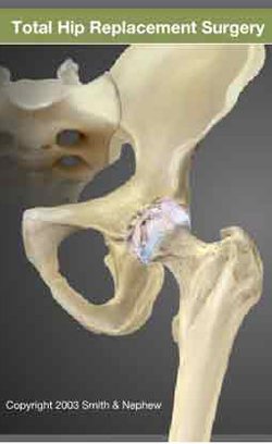 Total Hip Replacement Surgery
