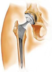 implanted hip